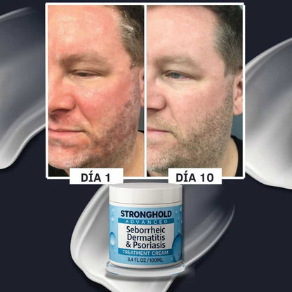 Advanced Seborrheic Dermatitis & Psoriasis Crema